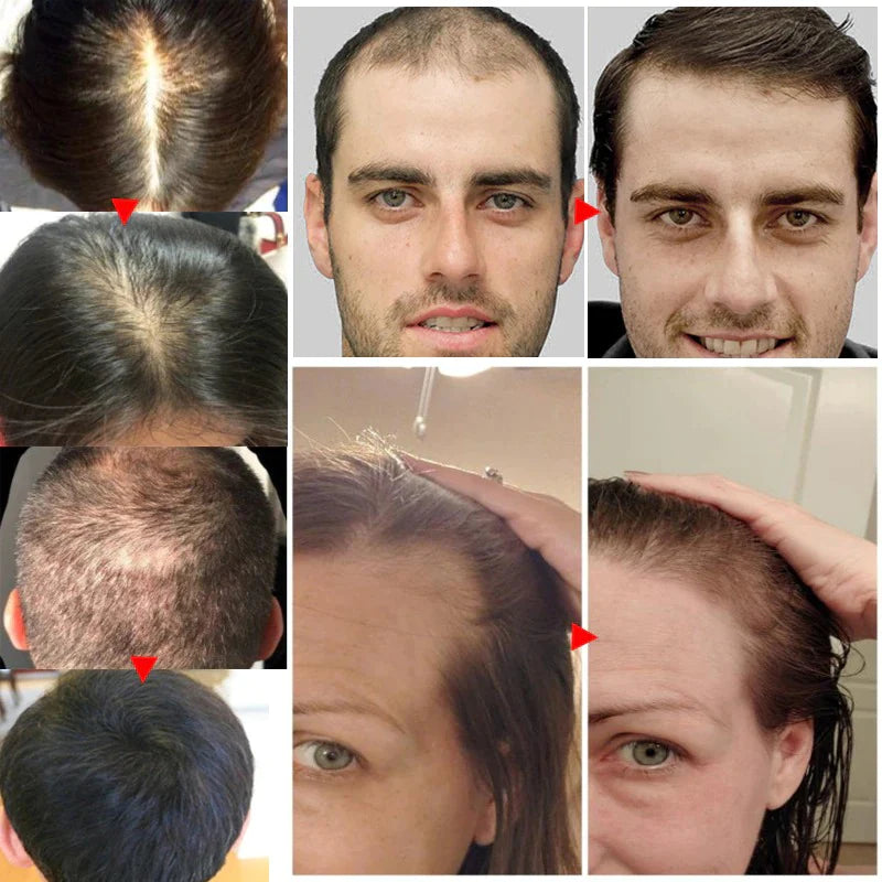 1+1 GRATIS | RevitaPro™ Haarwachstumsspray